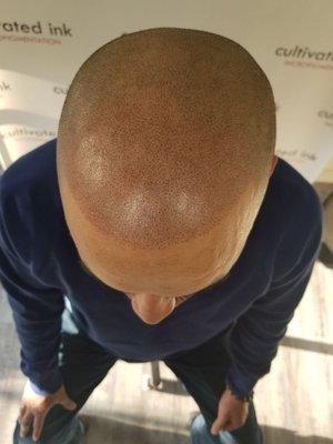 Scalp micropigmentation for male pattern baldness