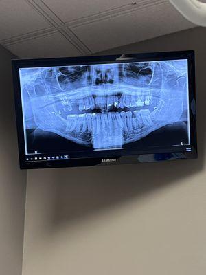 My teeth always go to dentist every 6 months don't neglect your teeth,pain is excruciating.