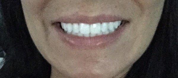 My smile & white teeth after Kors whitening