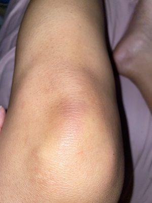 Bruises on my left knee