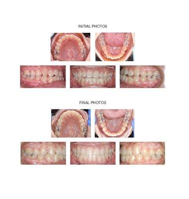 Adolescent with misaligned back teeth (class III) and crowding treated with braces.