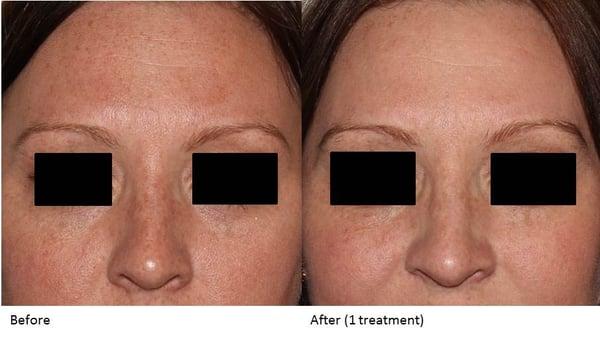 Sun Damage Laser Treatment: Before & After Photos from Dr. Rubenstein's Swedish Skin Institute (1 treatment).