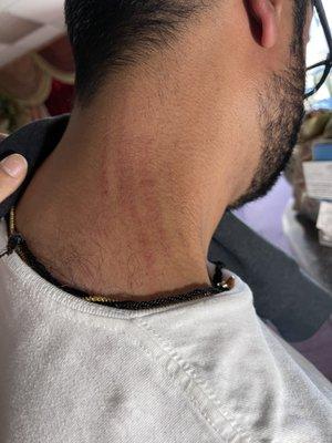 Scratches on neck from massage.