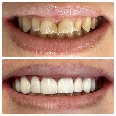 Before and after Veneers