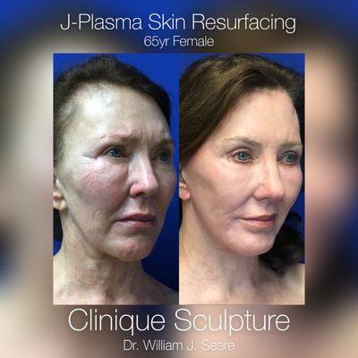 J-Plasma Skin Resurfacing