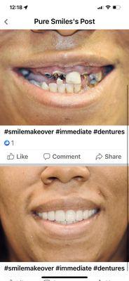 Immediate dentures