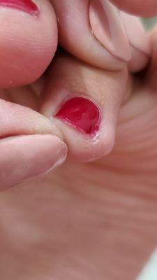 Dry skin around toe