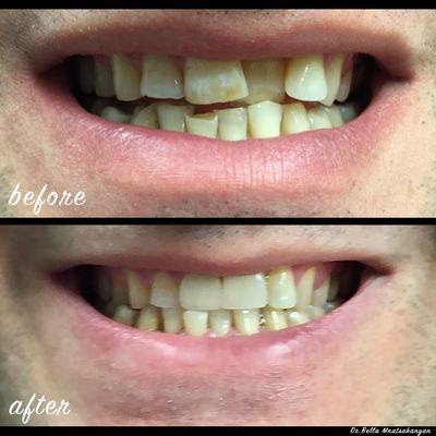 Challenging situation. The patient didn't want to go through orthodontic treatment. Ceramic crowns and composite restorations.