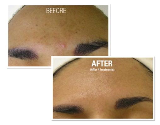 Hydrafacial results