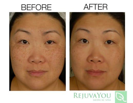 RejuvaYou can help get rid of sunspots and rejuvenate your skin!