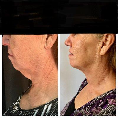 Ultherapy Skin Tightening and Kybella Fat Dissolving