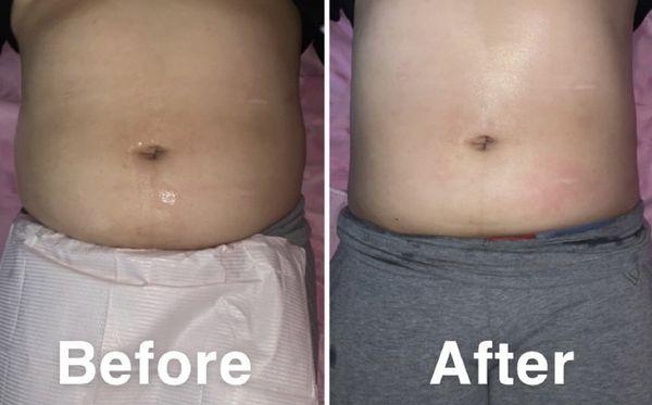 Before / After Cavitation