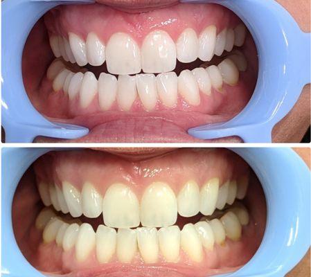 Lumina + Co. Teeth Whitening System before (below) and after (above)