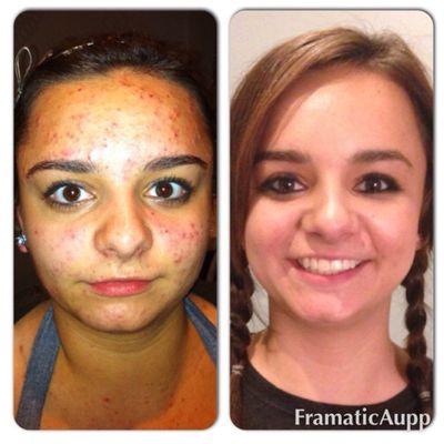 Before and after acne series of treatments. 5 PCA Peel treatments, 4 IPL Photofacials, 2  glycolic peels & tons of extractions.