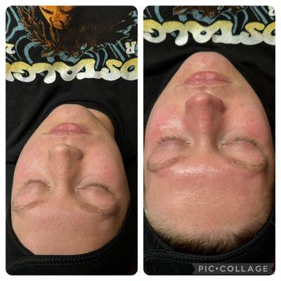 Hydrafacial glow