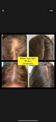 We treat women's hair loss too. 90 days of treatments and it's growing back super healthy.