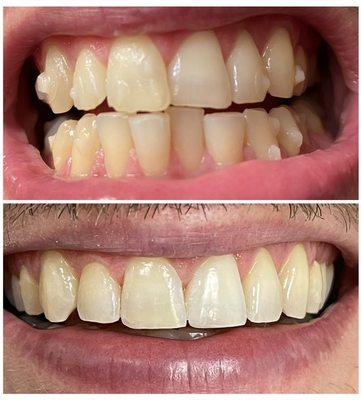 A Beautiful smile created with only Invisalign and minimal bonding.