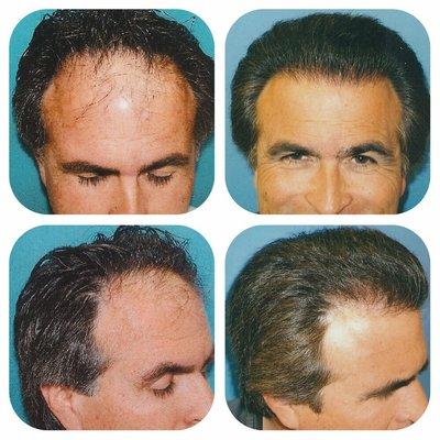 Grade four on NW scale, 3000 grafts using FUT and ultra refined microscopic technique.