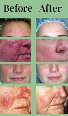 Before and After Treatments (IPL Procedures - 4 to 5 sessions)