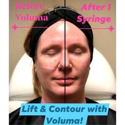 What a huge difference after just 1 syringe of Voluma to one cheek!