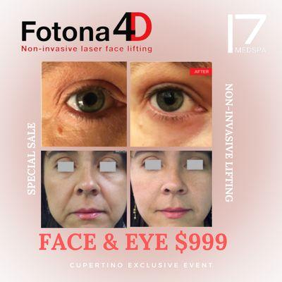 Fotona 4D is the world's first longest pulse laser! Lift your face and eye for only $999! Call now!