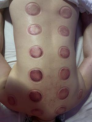 cupping