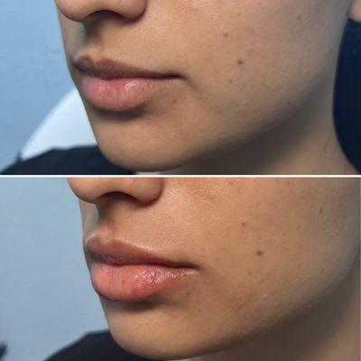 Minimal amount of HA filler was added to enhance the lateral parts of the patient's lips while maintaining her natural full lips.