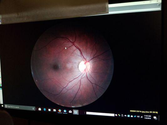 Retinal Picture