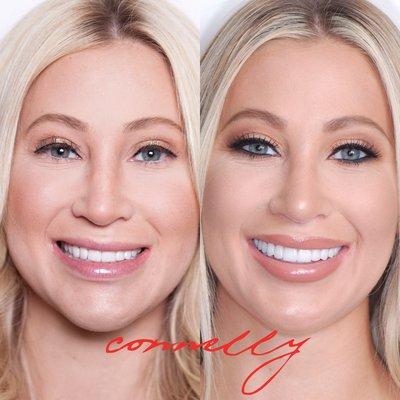 20 Porcelain Veneers