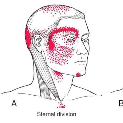 Ringing in the ears? Pain behind your eye? Nausea/dizziness? Could be a tight neck!