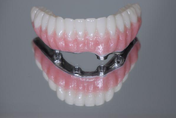 All on x fixed implant denture