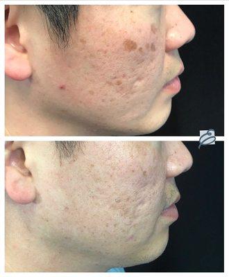 Picosecond laser removes dark spots safely and effectively at Erasable Inc. Tampa