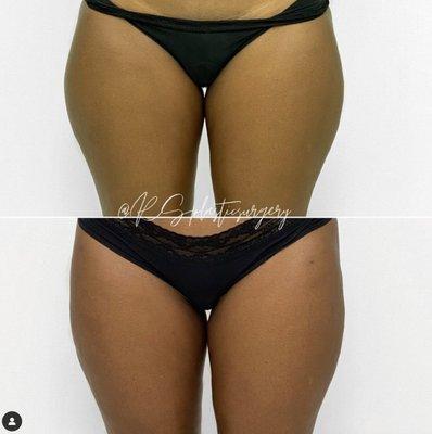 Liposuction of the thighs.