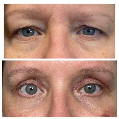 Upper and lower Blepharoplasty. Top: pre-op; bottom: 3 weeks post-op