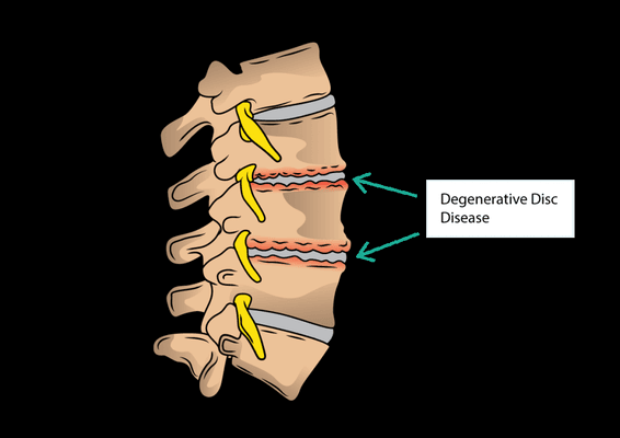 Disc Degeneration