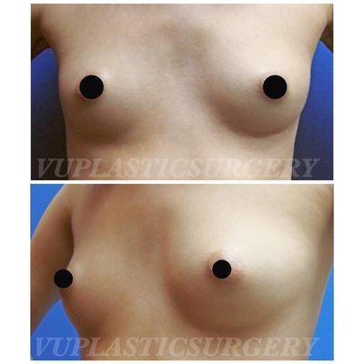 Before-Breast Augmentation with Saline Implants High Profile, Under the muscle. 380cc (3 year post)