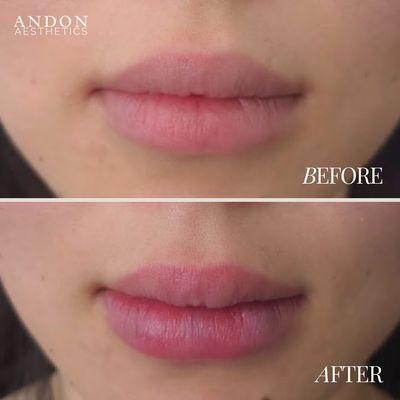 Anytime we do lip fillers, we want to build slowly to avoid migration! Notice the minimal enhancements!