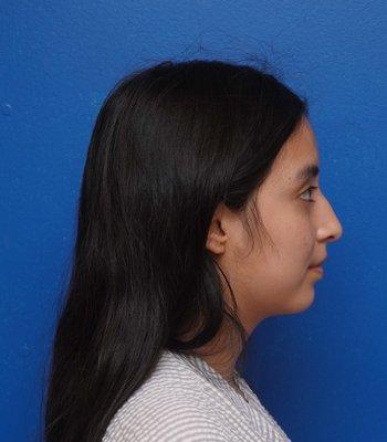 Before rhinoplasty. Patient concerns: dorsal hump and droopy tip.