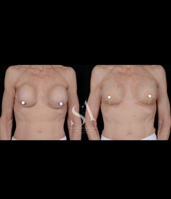 Conversion old ruptured and hard silicone implants previously placed over muscle to under and breast lift .  6 day result .