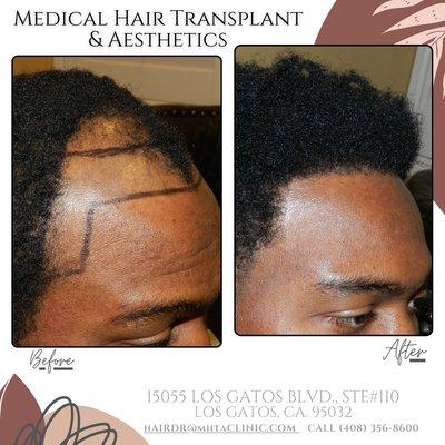 Medical Hair Transplant & Aesthetics