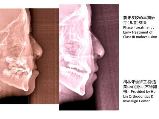 (provided by Hu Lin Orthodontics & Invisalign Center Copyright © 2018)胡林牙齿矫正专科-隐适美中心提供（不得翻拍）