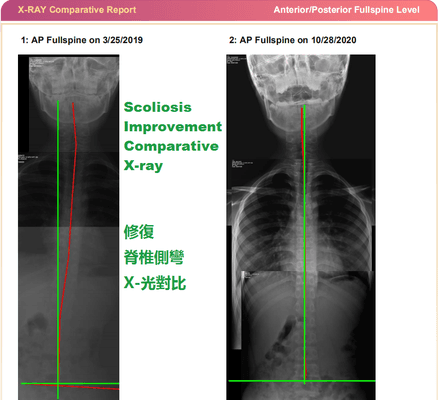 Scoliosis before and after