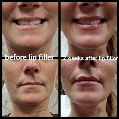 Juvederm Ultra Lip Filler