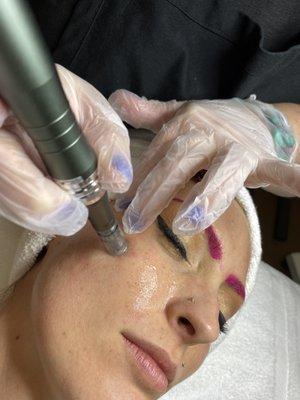 Microneedling