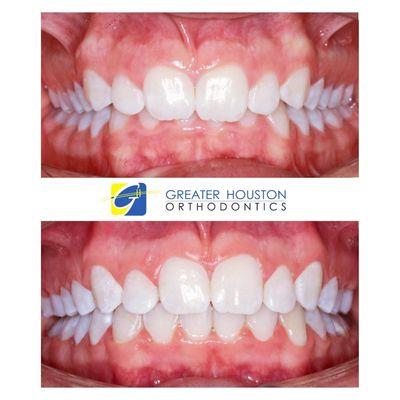 Before & After: Showcasing of one of our lovely patients who was treated by our board-certified orthodontist.