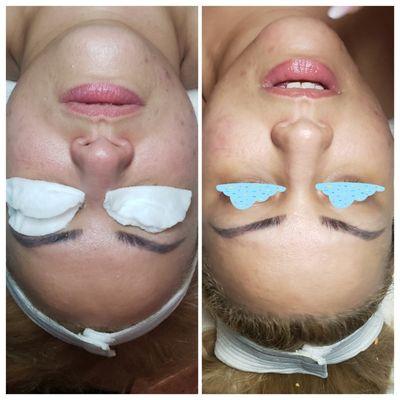 Before and after facial