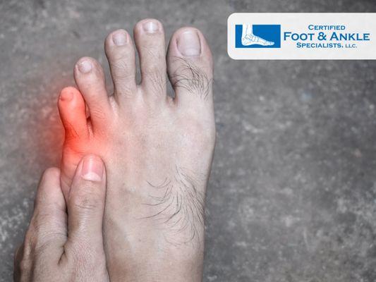 Bunion Pain Near the Pinky Toe