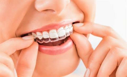 Invisalign at Archer Dental. Call now for your free consultation!