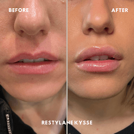 1 syringe of Restylane Kysse