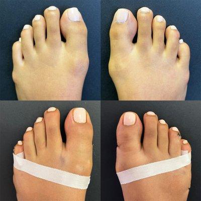 Bunion Removal Surgery